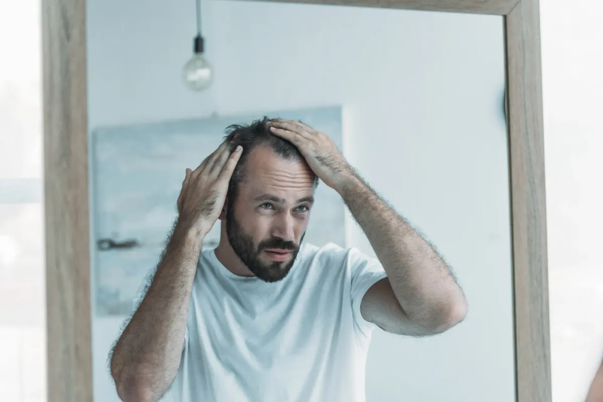 Alopecia Androgenética — Dermatologia Capilar na Clínica Mansur em Juiz de Fora