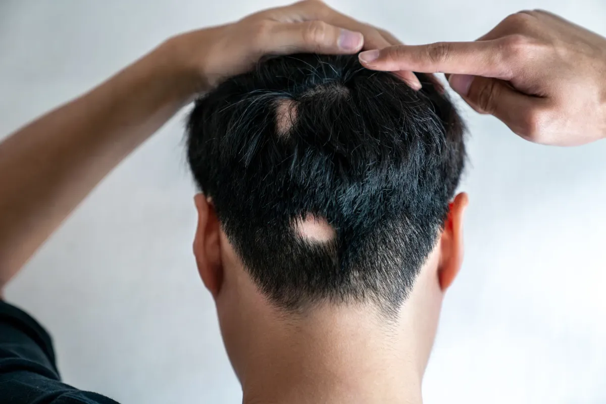 Alopecia Areata — Dermatologia Capilar na Clínica Mansur em Juiz de Fora