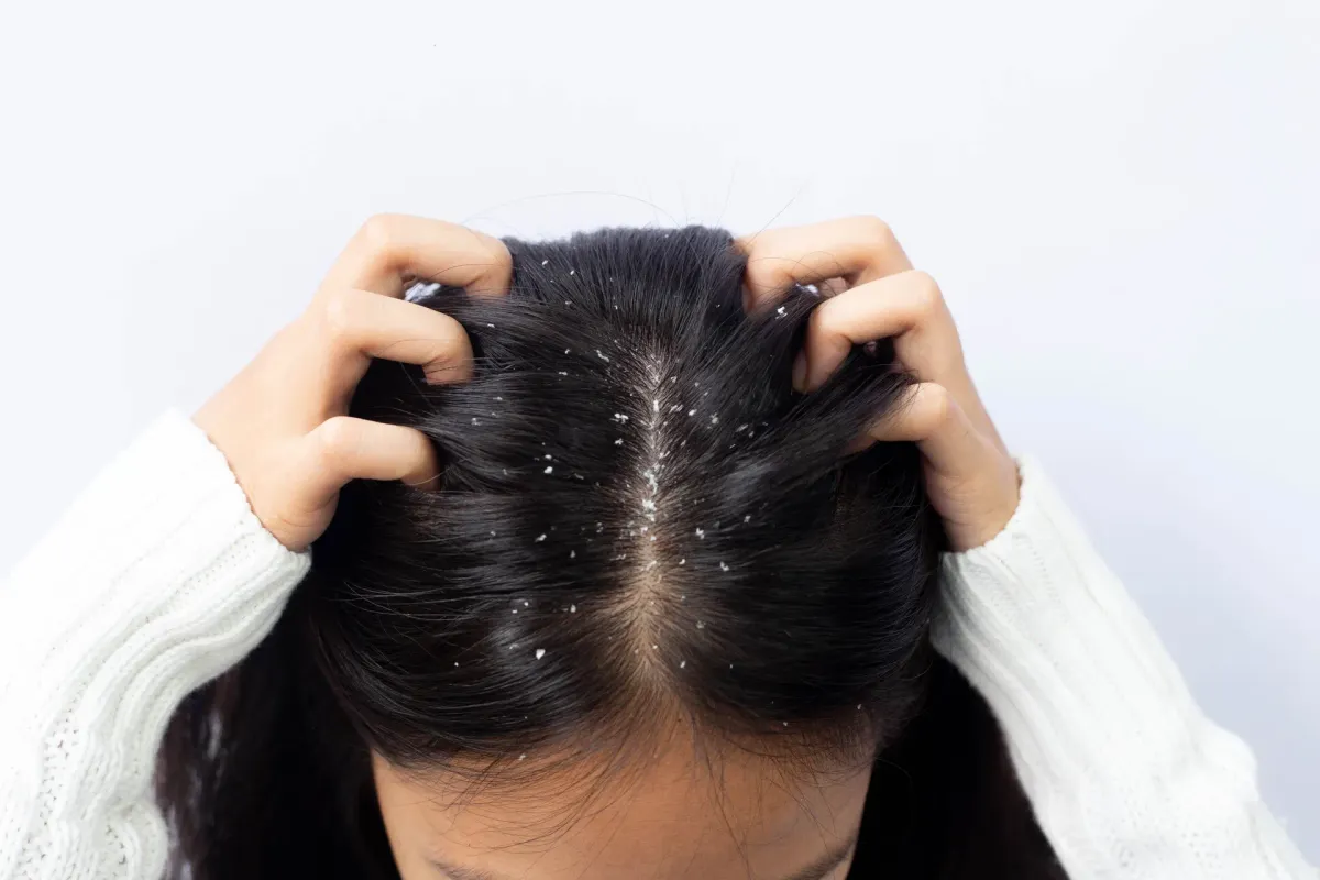 Dermatite Seborreica — Dermatologia Capilar na Clínica Mansur em Juiz de Fora