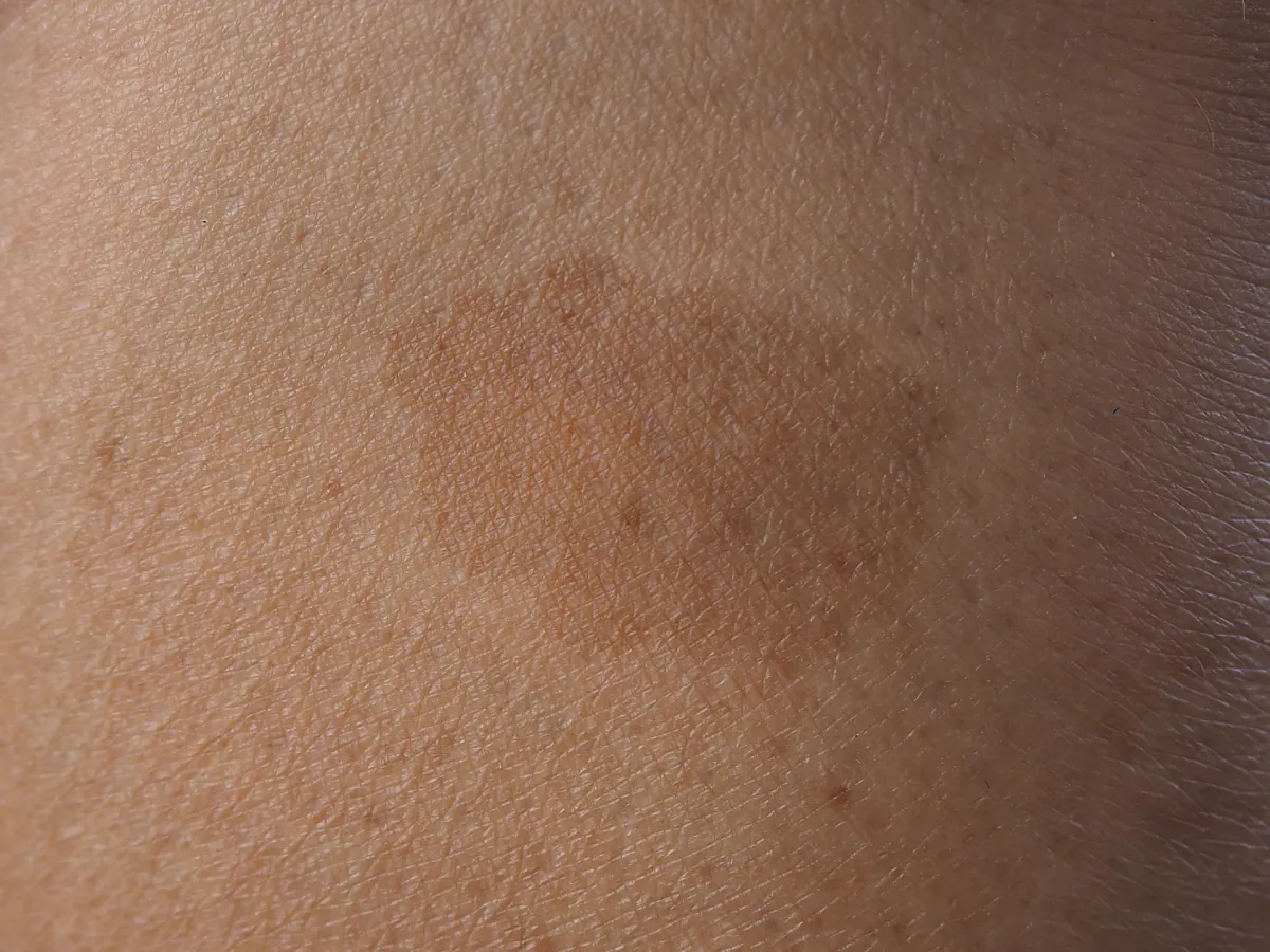 Manchas Café au Lait — Dermatologia Clínica na Clínica Mansur em Juiz de Fora