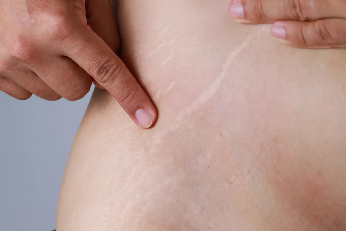 Estrias — Dermatologia Estética na Clínica Mansur em Juiz de Fora