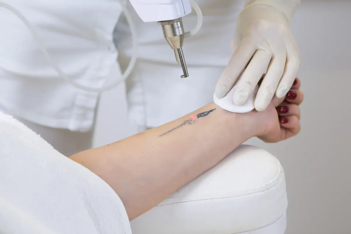 Remoção de Tatuagem — Dermatologia Estética na Clínica Mansur em Juiz de Fora